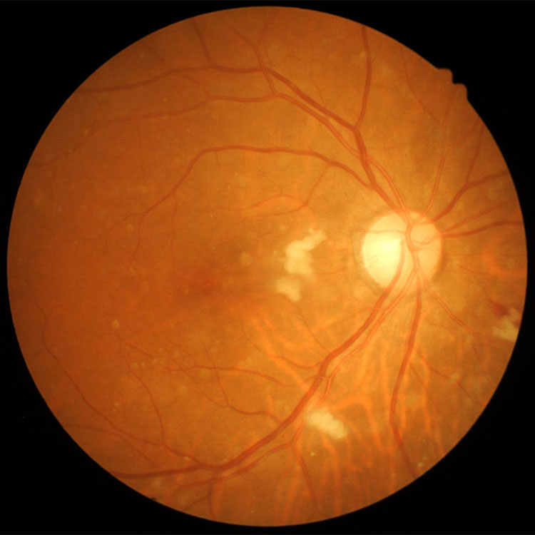 Internal view of eye