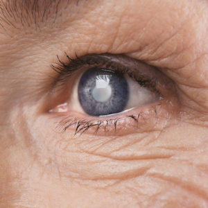 elderly woman with cataracts